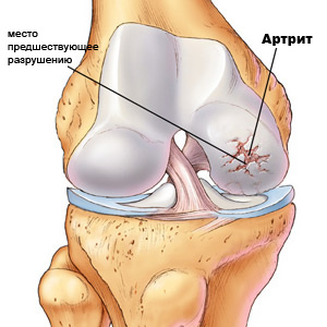 болезни  ног: артрит