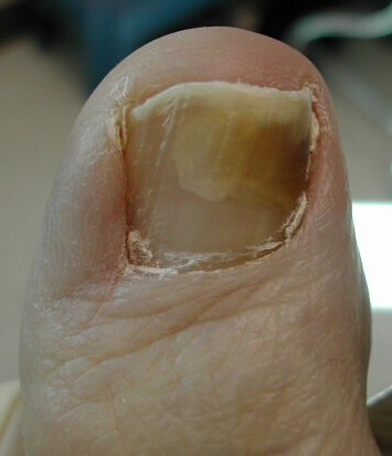 болезни  ногтей
